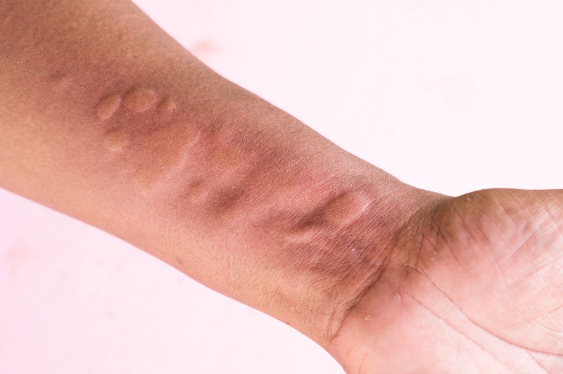 荨麻疹怎么治疗较好