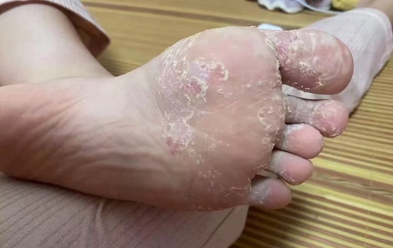 患脚气病是缺乏什么维生素