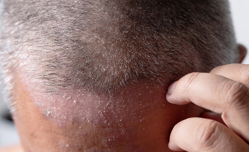 治疗牛皮癣较好的方法是哪种